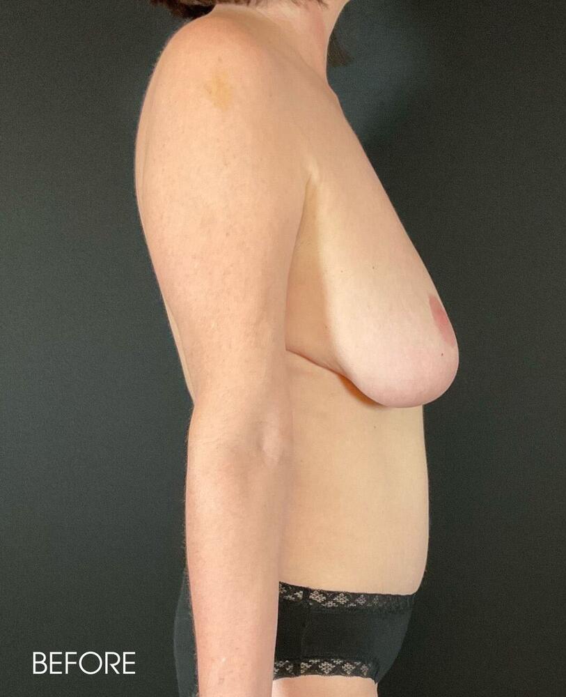 Breast Lift Before & After Image