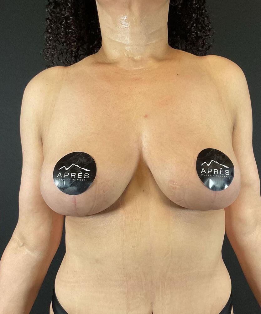 Breast Lift Before & After Image