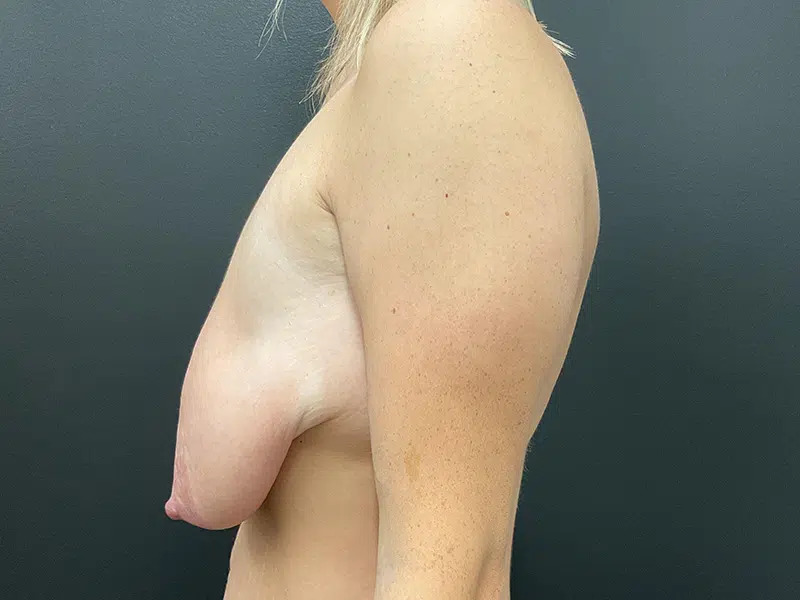 Breast Lift Before & After Image