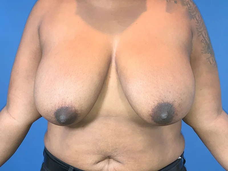 Breast Reduction Before & After Image