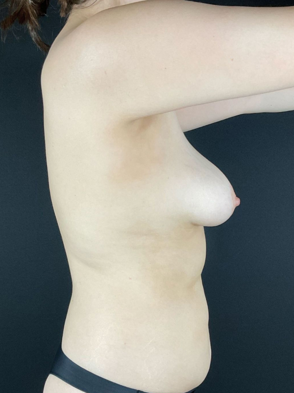 Fat Grafting Before & After Image