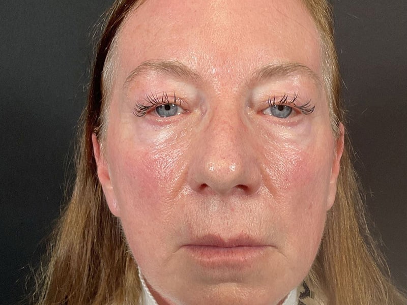 Eyelid Lift Before & After Image