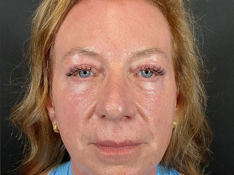 Eyelid Lift Before & After Image