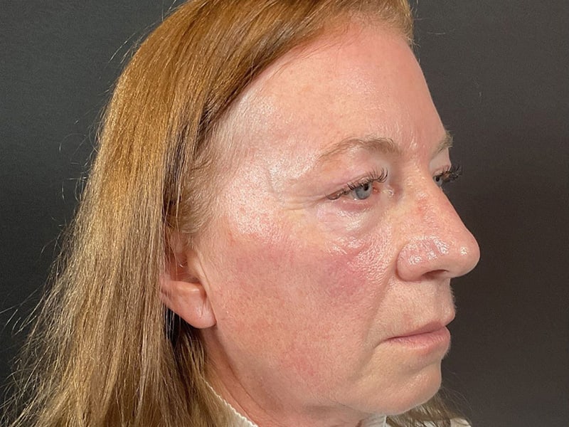 Eyelid Lift Before & After Image