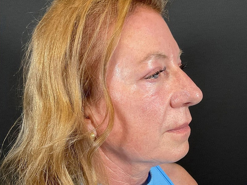 Eyelid Lift Before & After Image