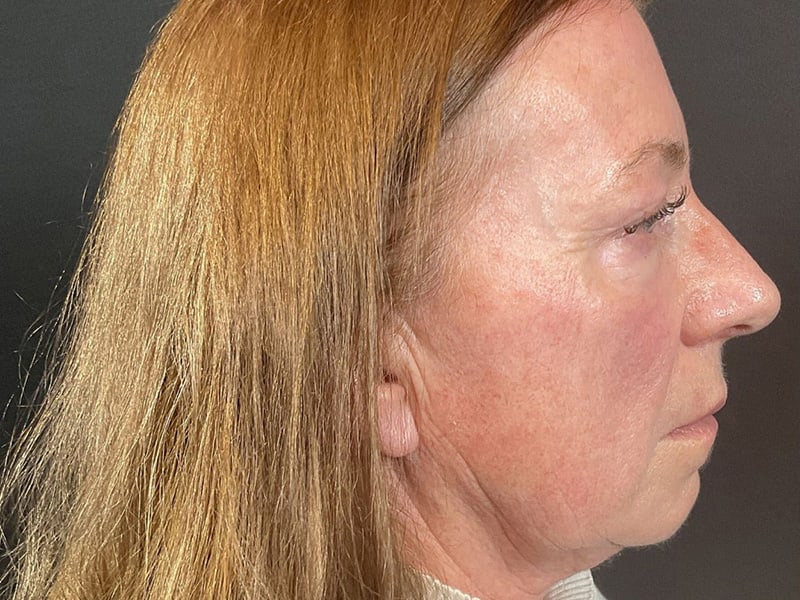 Eyelid Lift Before & After Image