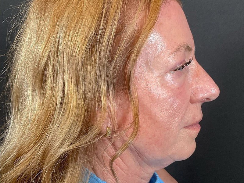 Eyelid Lift Before & After Image