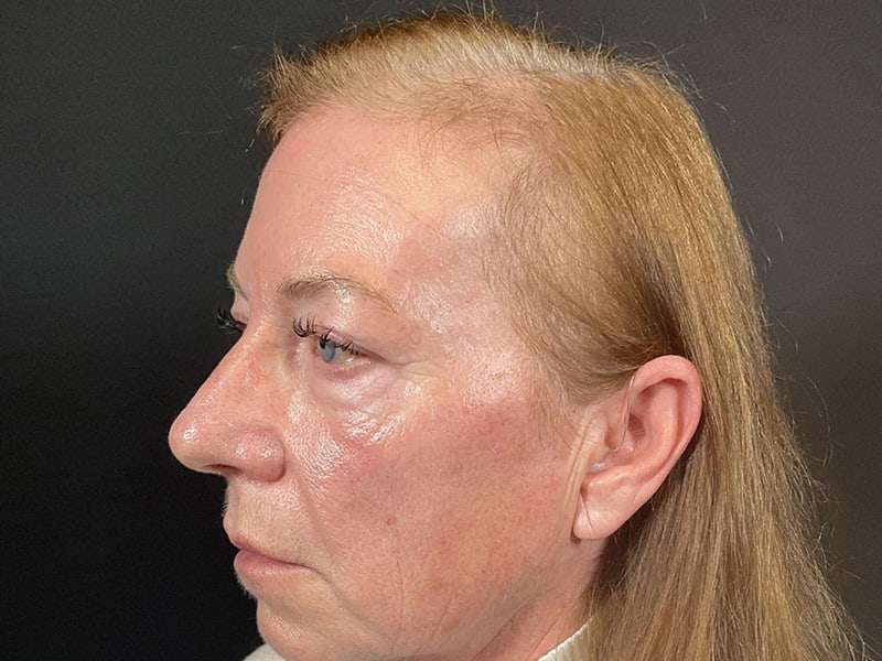 Eyelid Lift Before & After Image