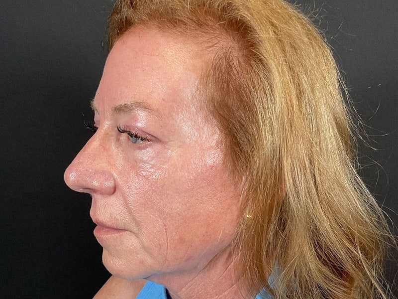 Eyelid Lift Before & After Image