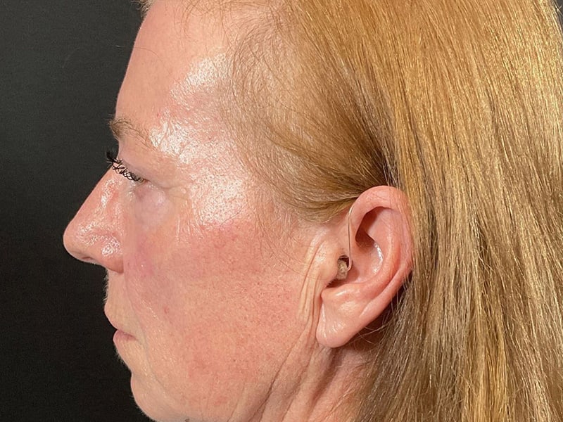 Eyelid Lift Before & After Image