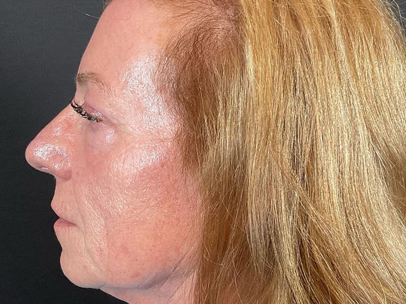Eyelid Lift Before & After Image