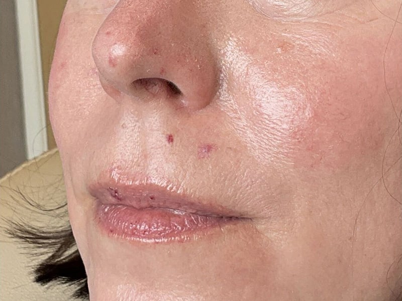 Filler Before & After Image