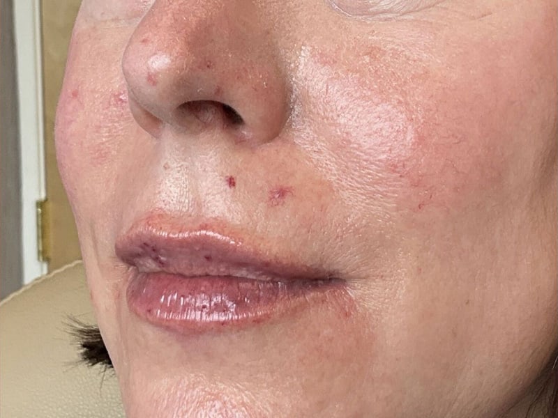 Filler Before & After Image