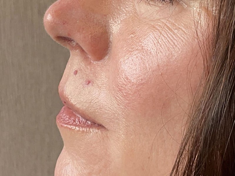 Filler Before & After Image