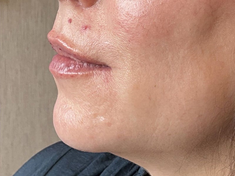 Filler Before & After Image