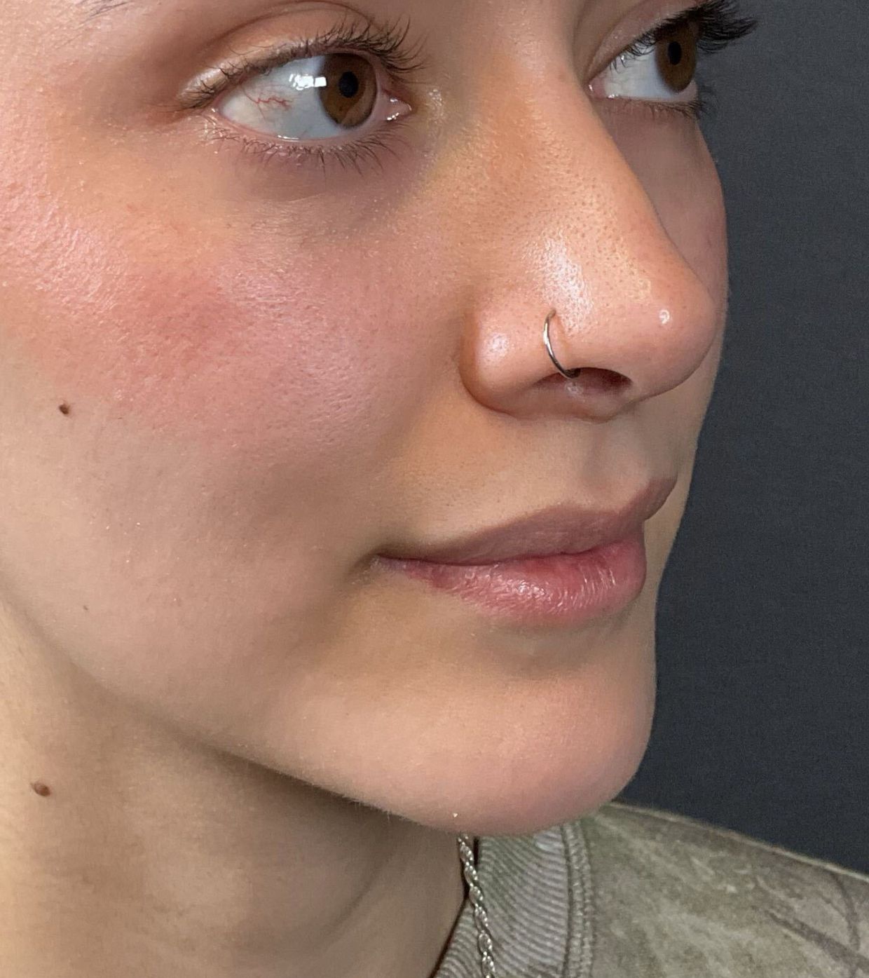 Filler Before & After Image
