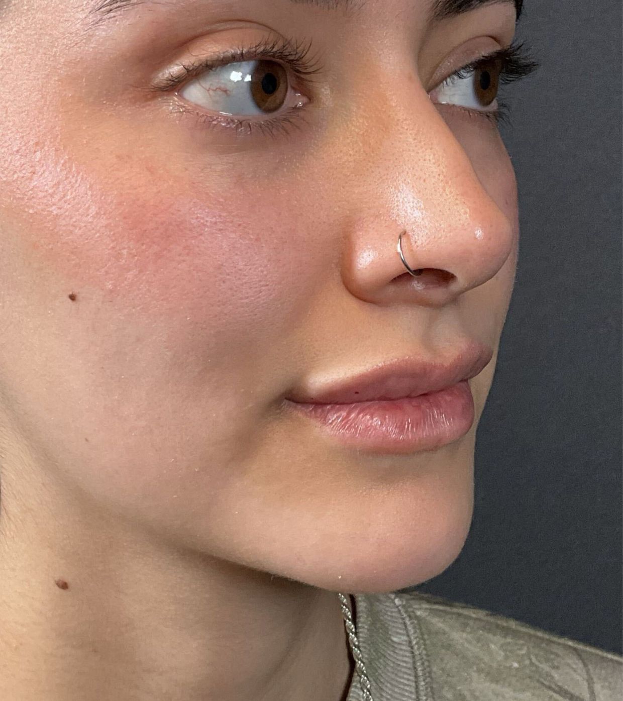 Filler Before & After Image