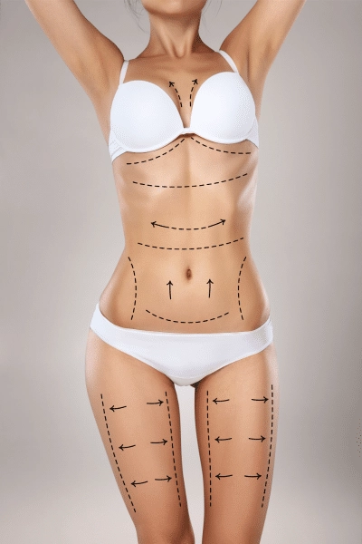 Vaser Liposuction Recovery Time