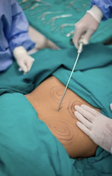 Fat removal surgery