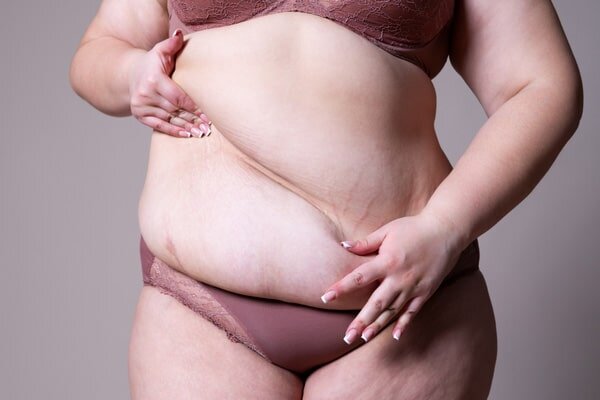 Is liposuction covered by insurance