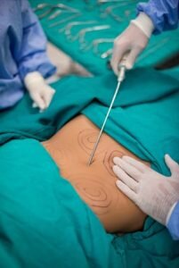 Liposuction