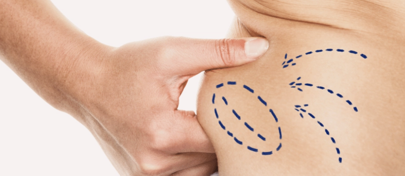 Vaser Liposuction Pros and Cons