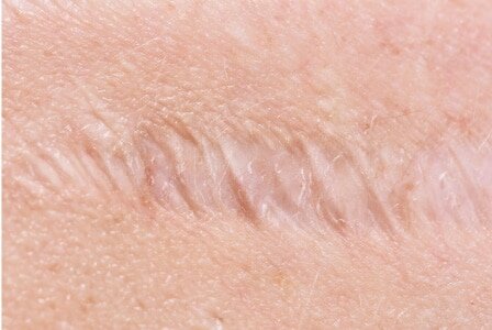 Tummy tuck scar