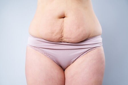 Tummy tuck scars after 1 year