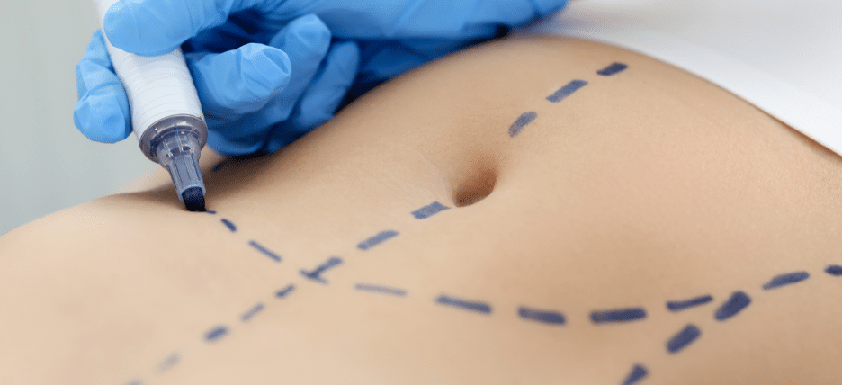How Much Does Vaser Liposuction Cost?