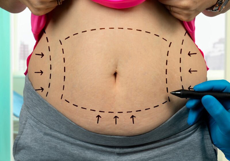 Best Liposuction Recovery & Tips