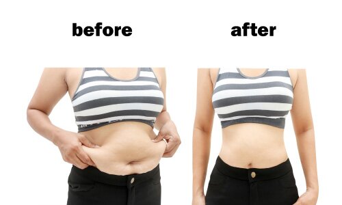 Post liposuction care