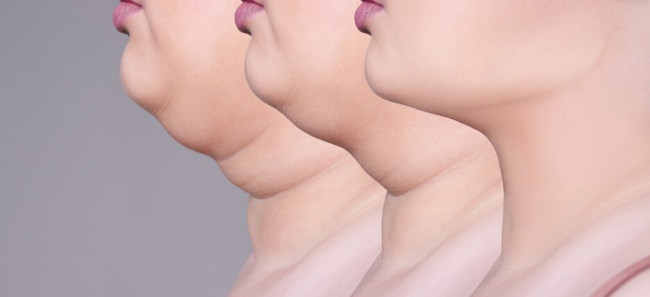 Are You a Good Candidate for Double Chin Liposuction?