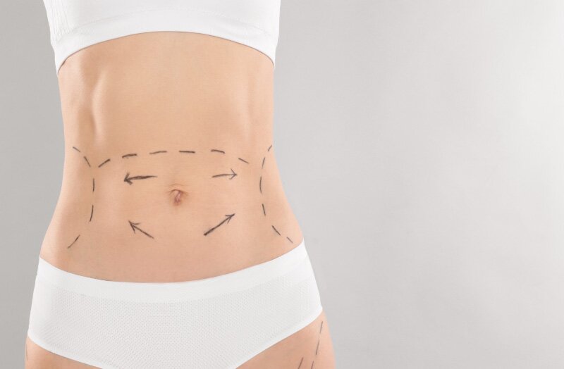 Stomach Lipo Before and After What to Know
