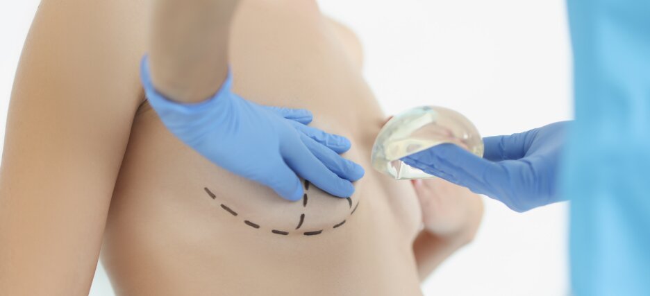 What to Expect From Breast Implants Scars