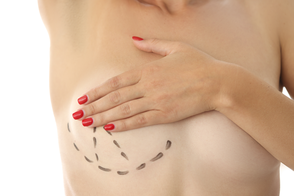 Questions To Ask Before Breast Lift