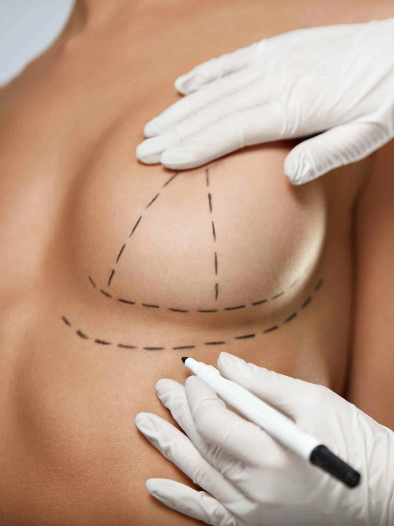 breast-lift