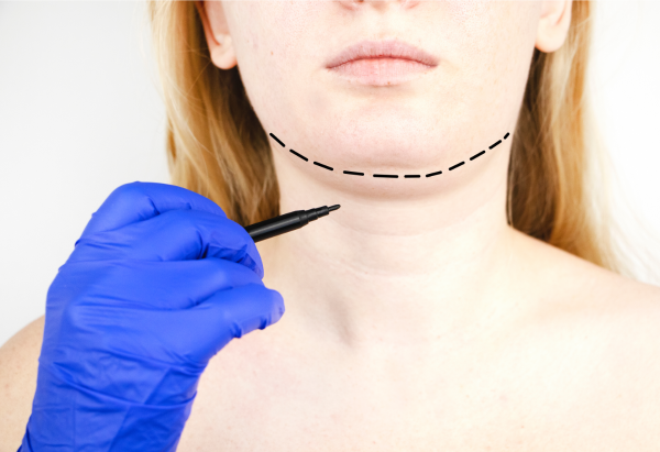 Celebrity Chin Liposuction Before And After
