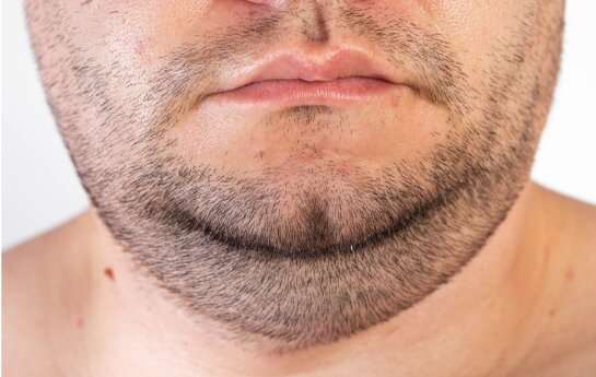 Chin Liposuction Cost Near Me