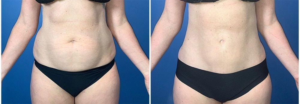 vaser-liposuction-03