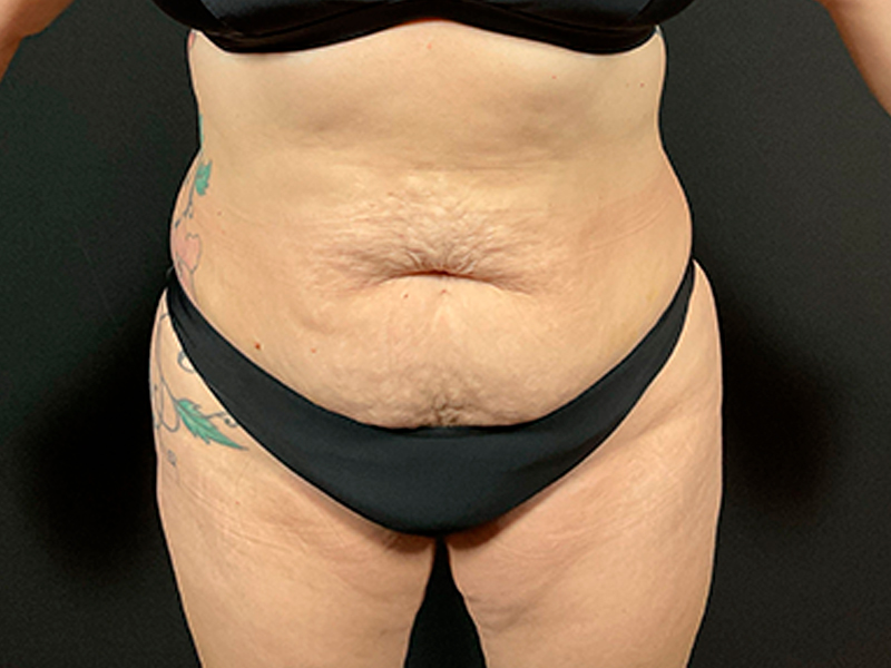 tummytuck-20-1