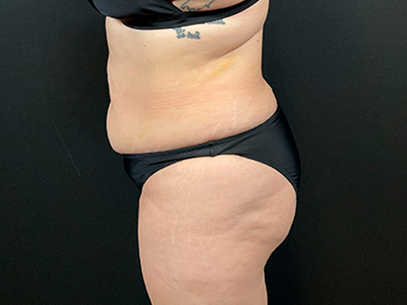 tummytuck-20-5