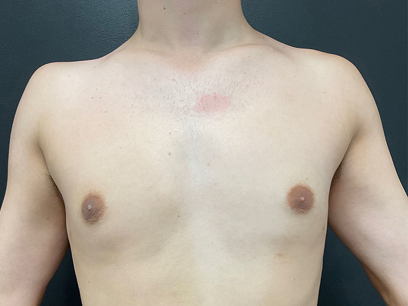 Gynecomastia-3-a1