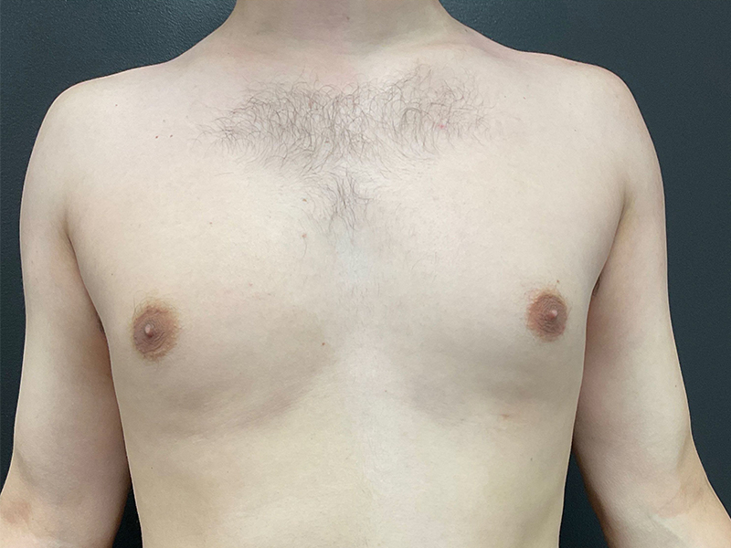 Gynecomastia-3-b1