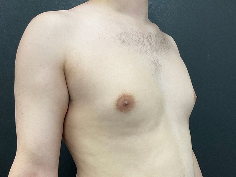 Gynecomastia-3-b2