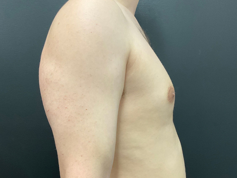 Gynecomastia-3-b3