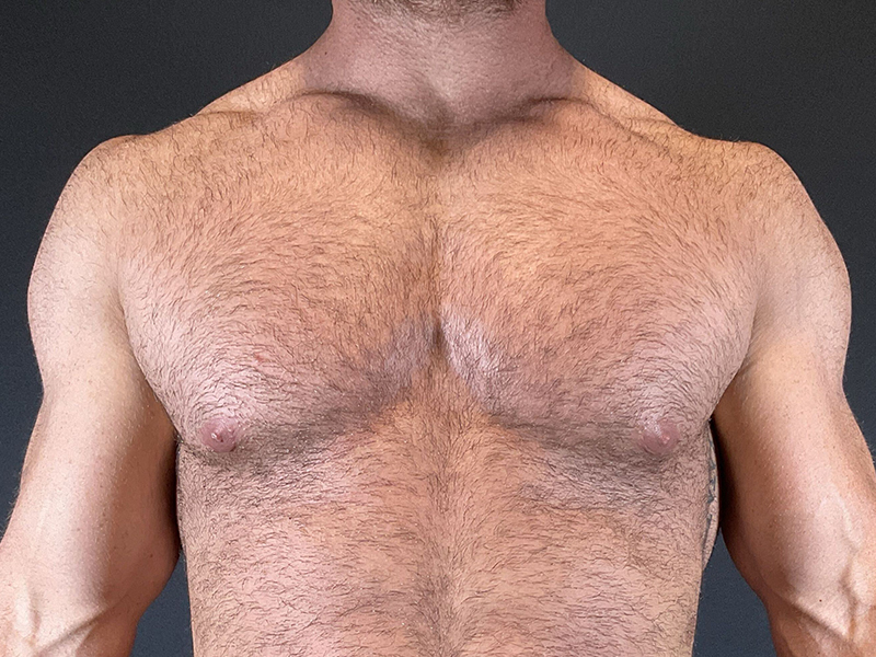 Gynecomastia-4-a1