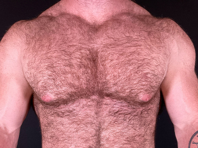 Gynecomastia-4-b1
