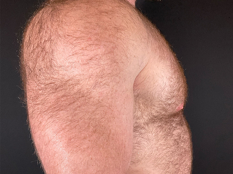 Gynecomastia-4-b3