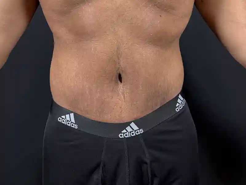 Lower-Bodiy-lift-patient-7-A1