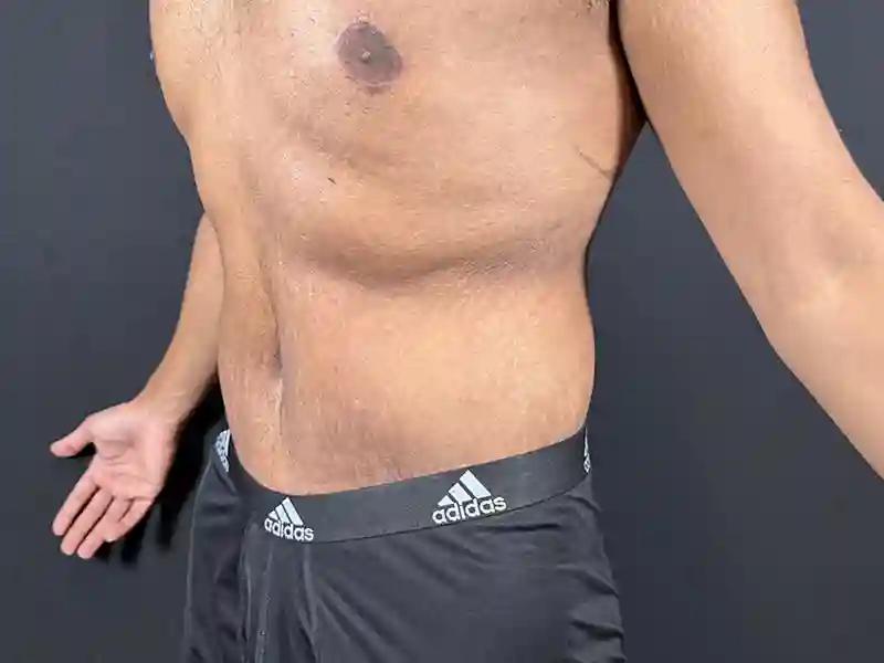 Lower-Bodiy-lift-patient-7-A2